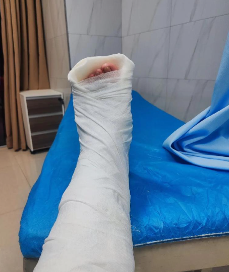 如果骨折比较轻微,可以用硬木板或石膏固定受伤的腿