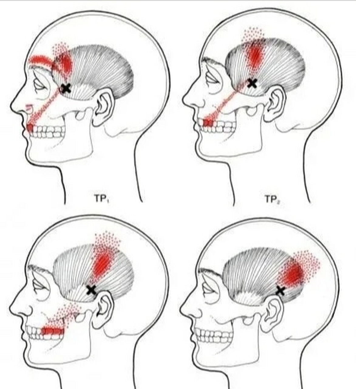 颞肌疼痛图片