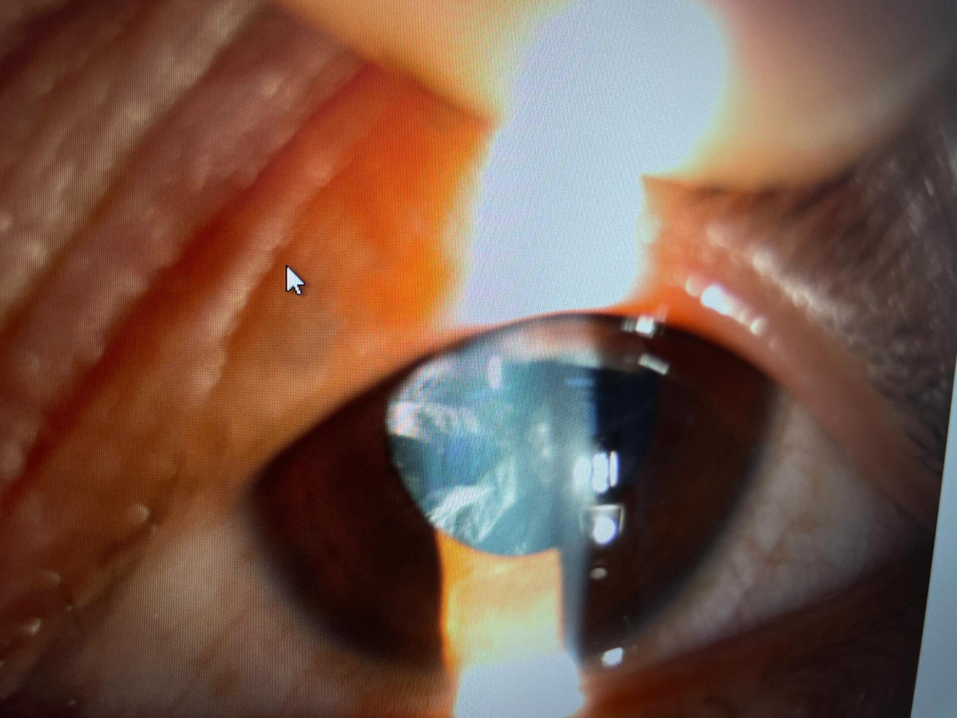 30岁左右白内障一例 照片分别为右眼和左眼的前节照相,可见晶状体较为