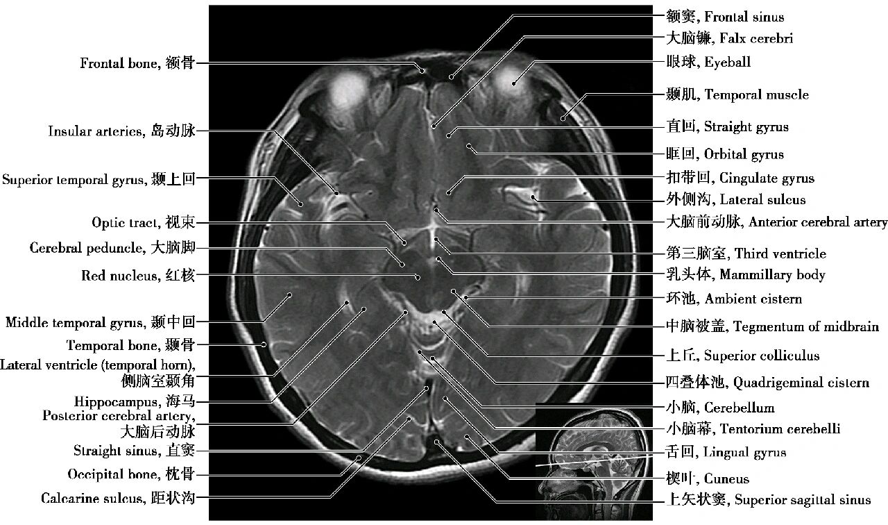 头部磁共振解剖(轴位)