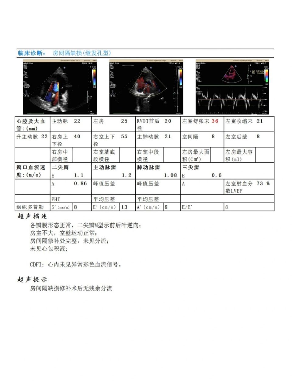 房缺修补术后检查 这个二尖瓣m型示前后叶逆向是什么意思呀?