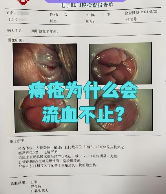 痔疮流血不止最常见的原因是内痔静脉破裂或外痔小动脉破裂