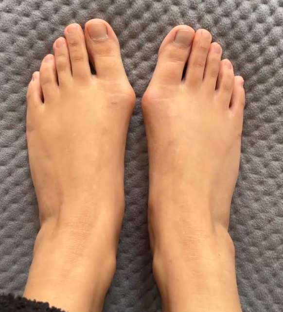 第二个脚趾弯曲伸不直,可能和先天性发育畸形,拇外翻或者外伤有关