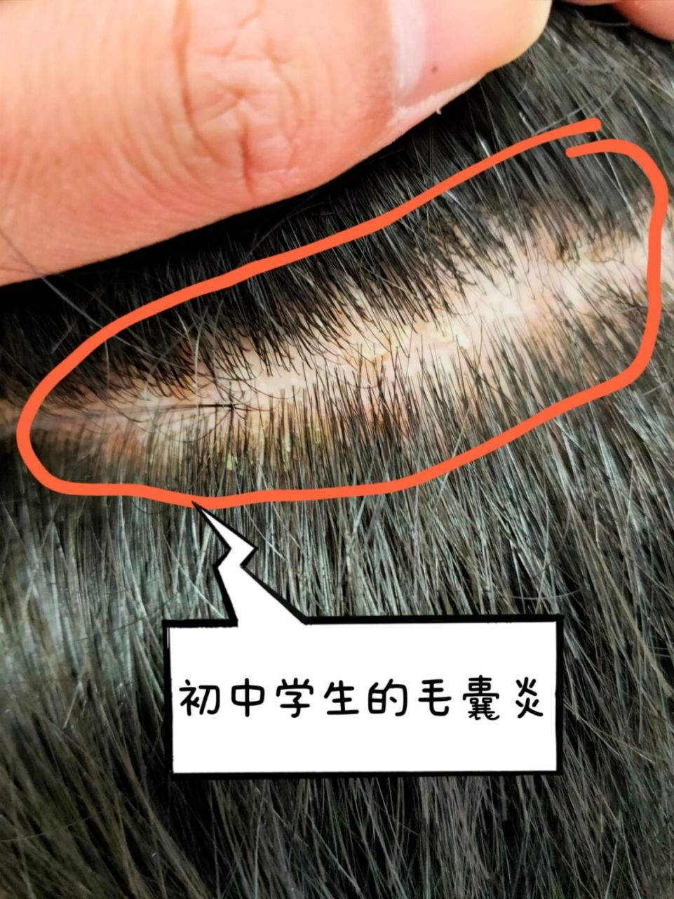 毛囊炎 这是初中同学生的毛囊炎!