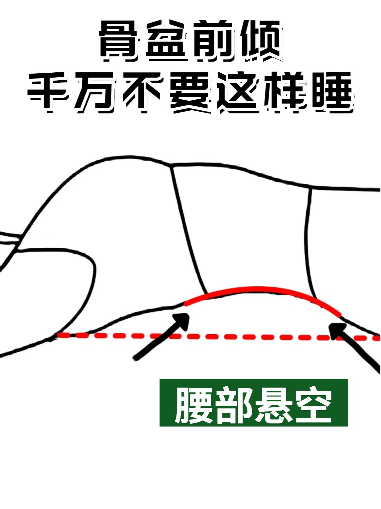 这样睡觉真的能改骨盆前倾02 亲爱的小伙伴们