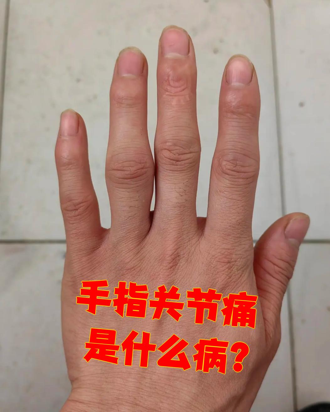 手指关节痛可能由多种疾病引起,最常见的是风湿性关节炎,骨关节炎和