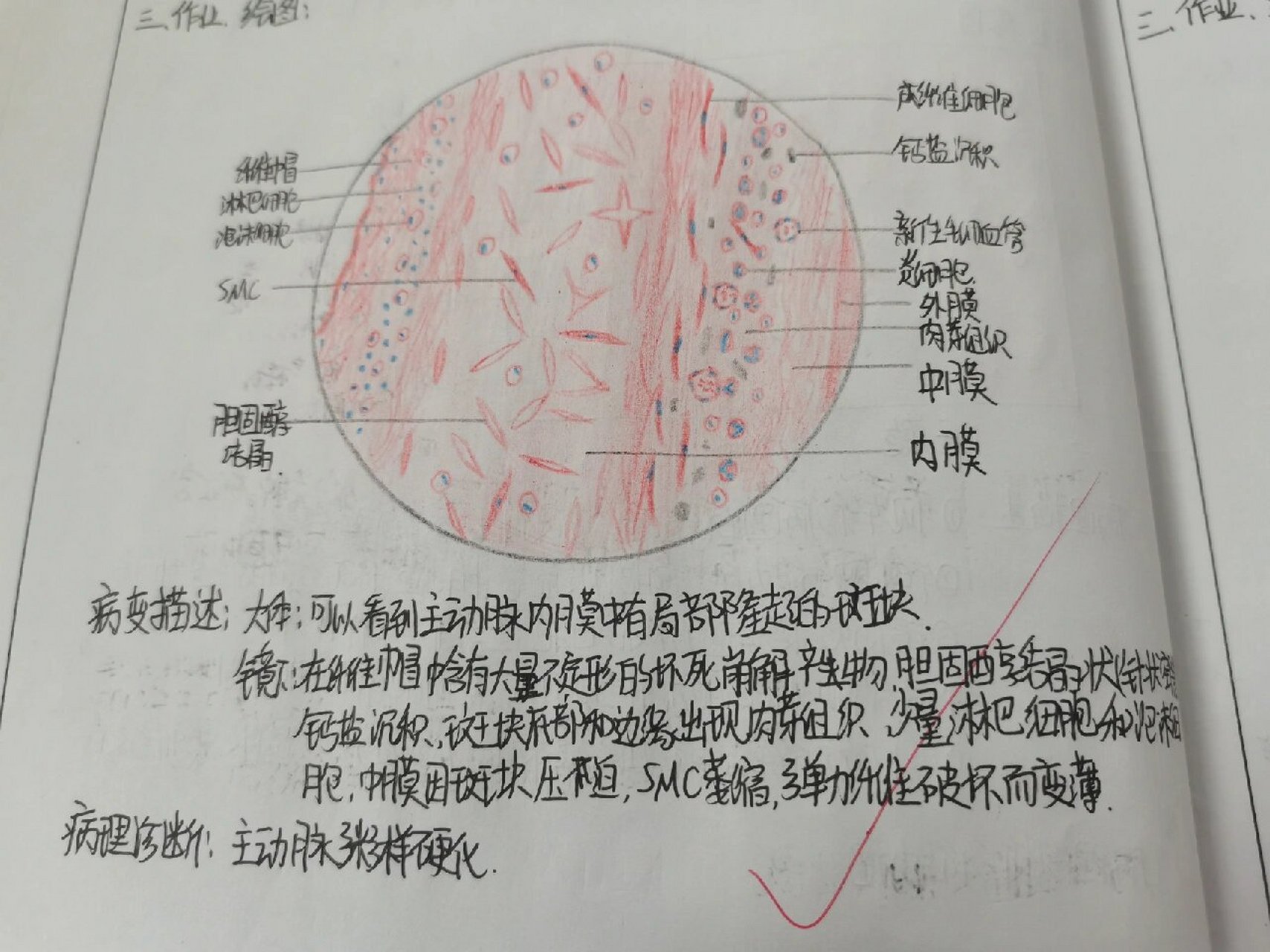 动脉粥样硬化切片图解图片