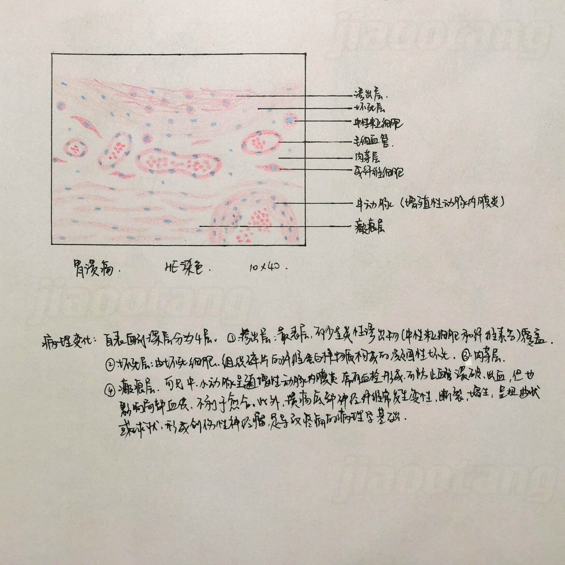 病理学实验报告红蓝铅笔绘图(胃溃疡) 95胃溃疡     he染色    10x