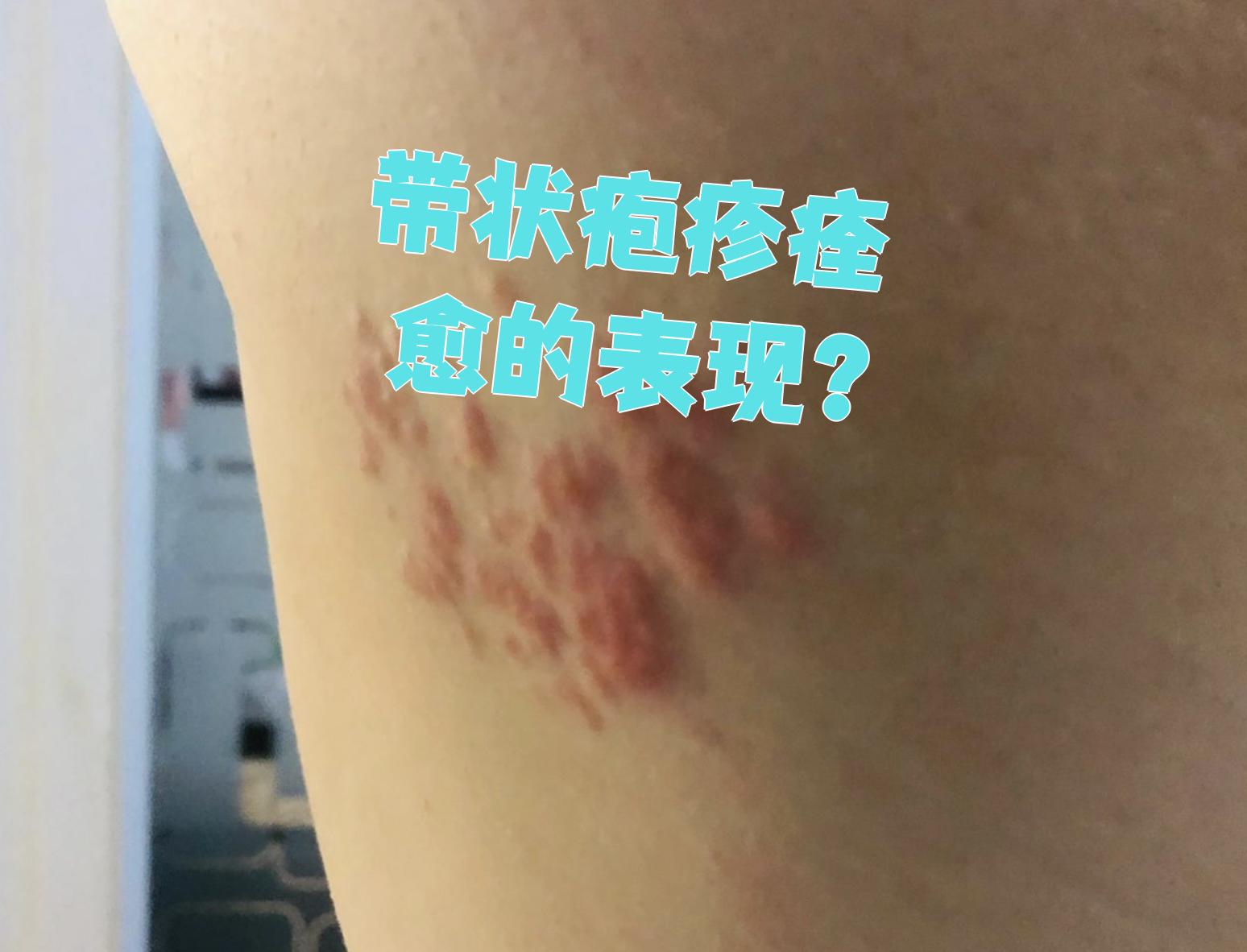 为什么结痂的时候特别痒为什么在线