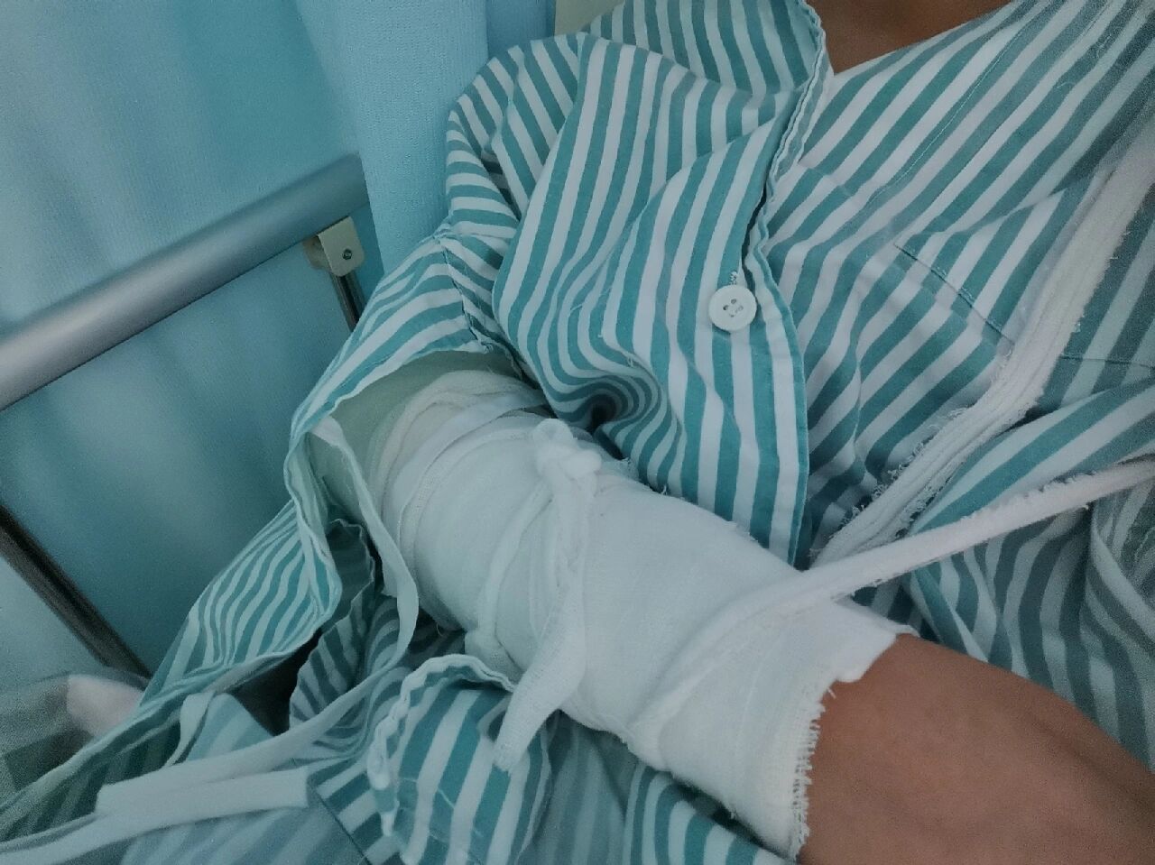 左手桡骨小头骨折 问了两个医院都说要打钢钉,前天已经住院了.