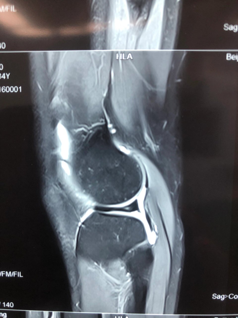 外侧盘状半月板损伤核磁表现 今天两台手术之一,外侧盘状半月板损伤