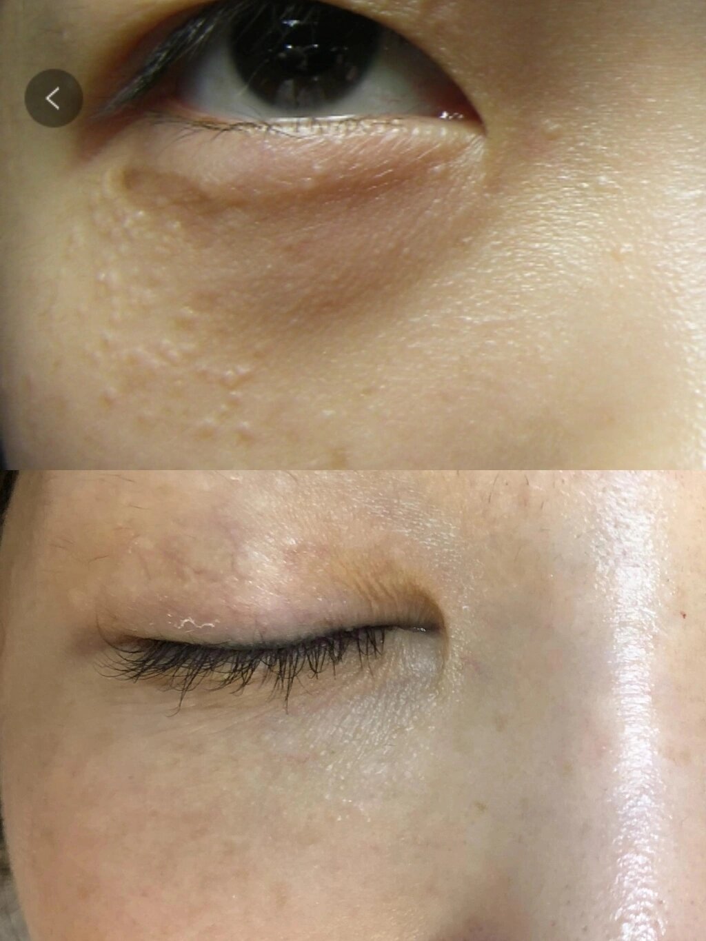 时间见证我的汗管瘤真的可以去掉 跟我一样有汗管瘤的姐妹一定要坚持