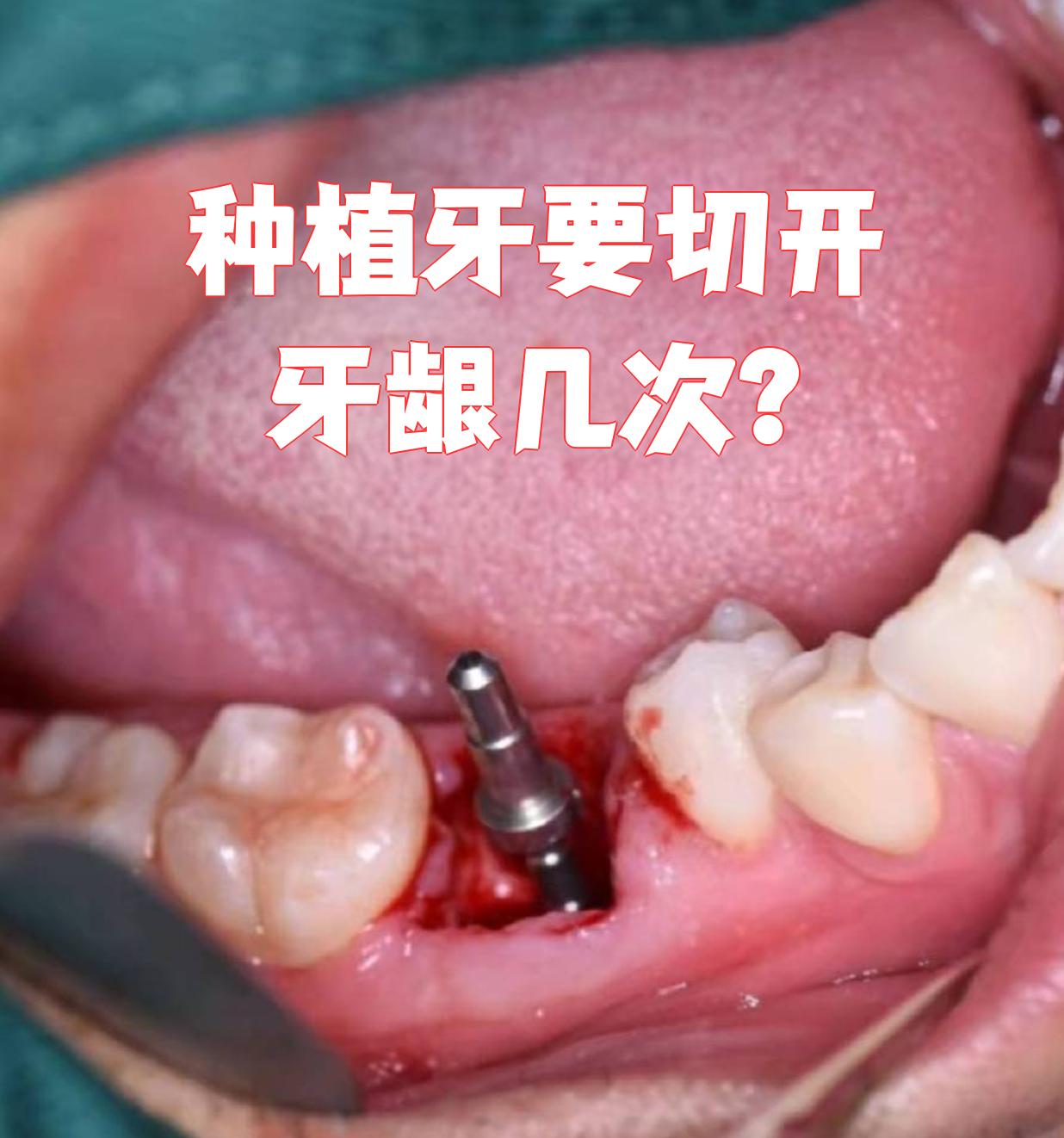 栽培牙腾讯广告投进战略
