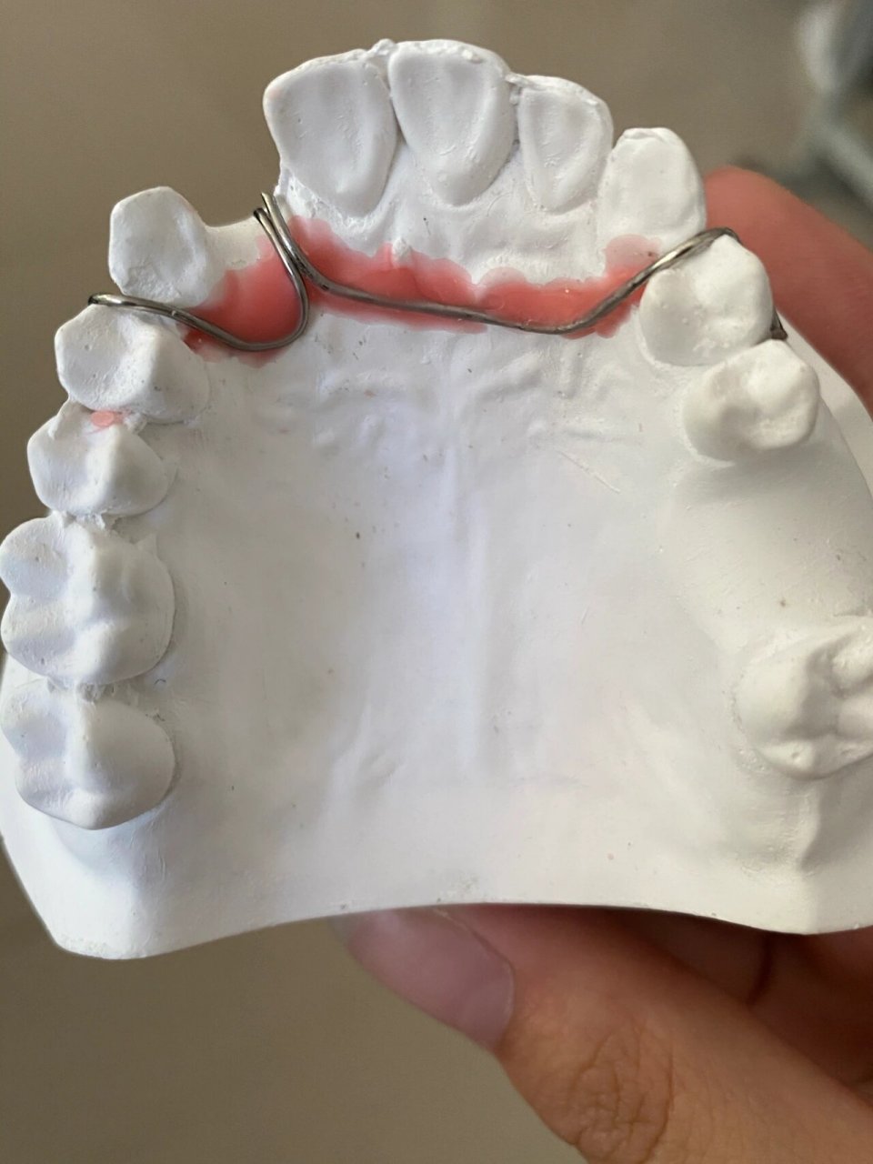 口腔医学日常|前牙间隙卡环弯制 没有机器前牙就没打磨,有点高