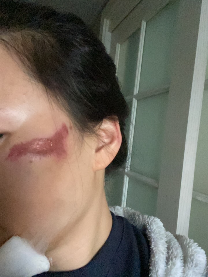 脸部擦伤怎么办?皮肤变黑求推荐复原办法