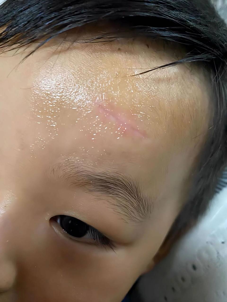 姐妹们,我家娃额头上的缝针疤痕经过我的不懈努力,终于消失了!