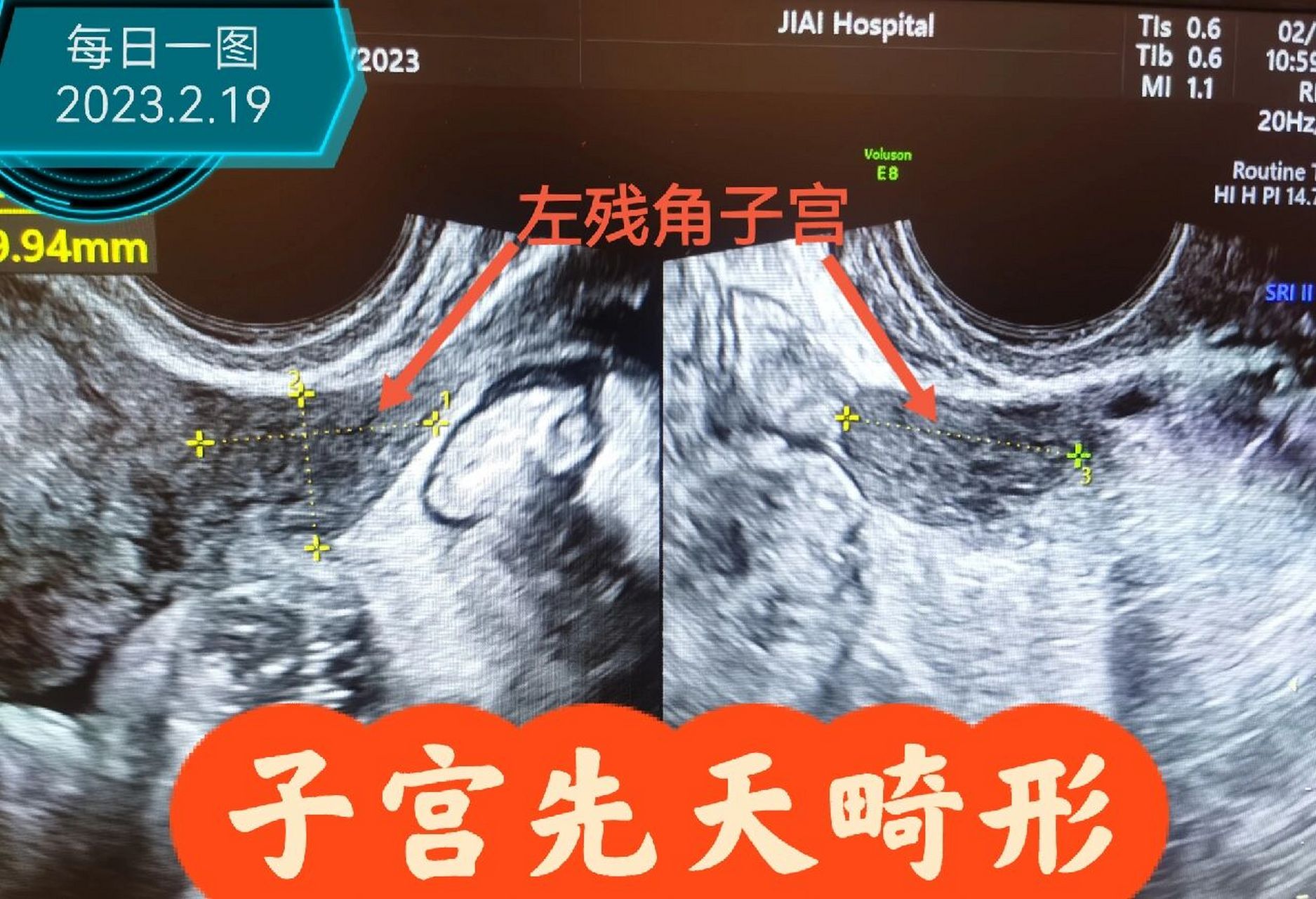 残角子宫分型图片图片