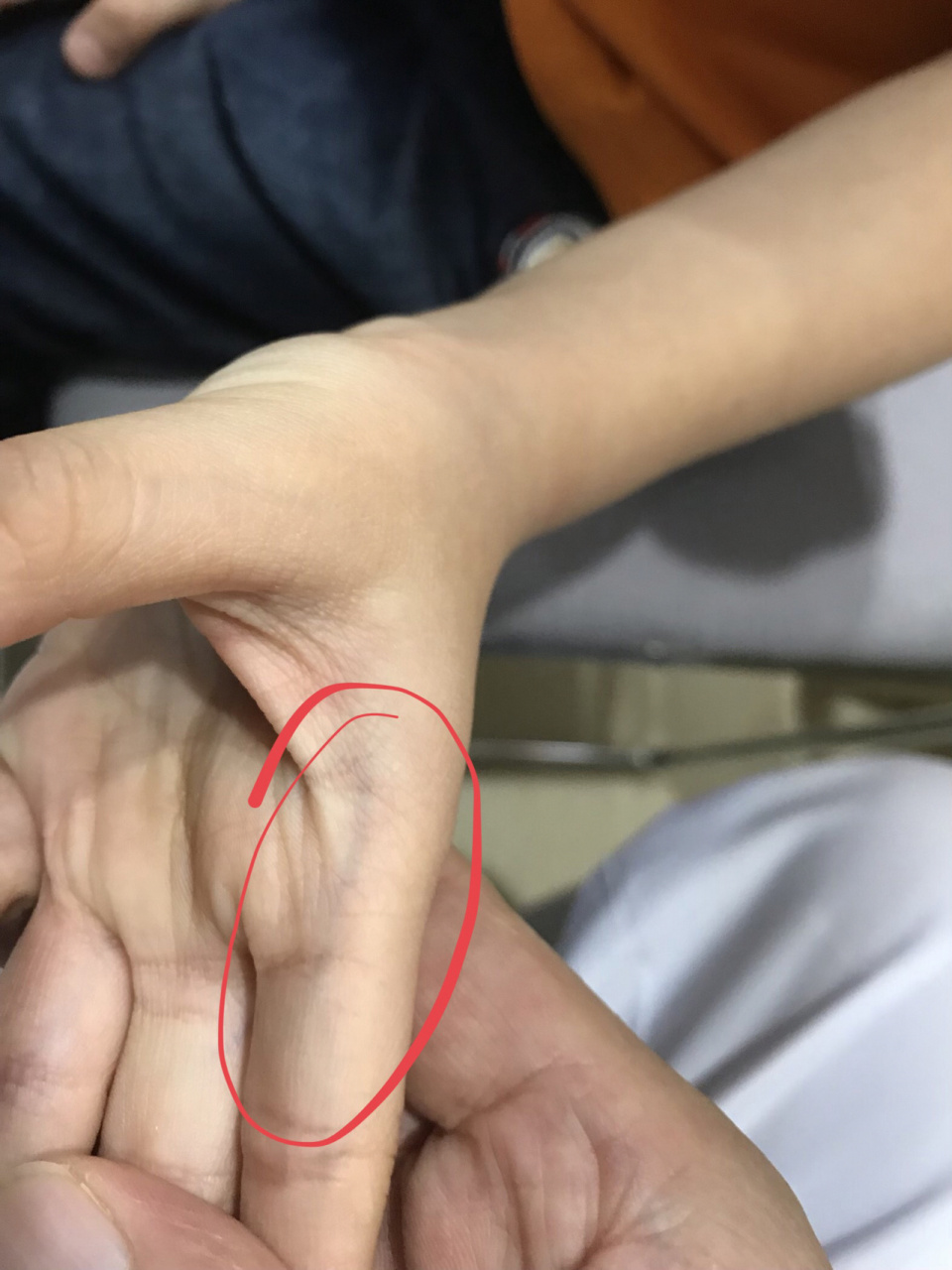 小儿指纹色紫红,家长要当心 小儿指纹的变化可以反映儿童的虚实寒热.