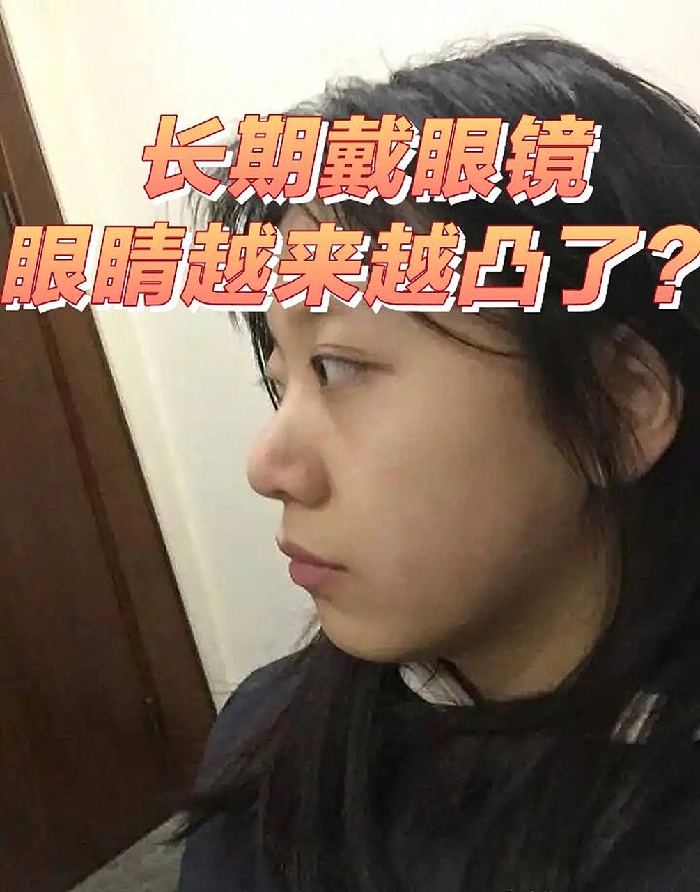 跟啤酒瓶90底一样厚了" "取了眼镜,眼睛无神,而且眼球很凸,不戴眼镜