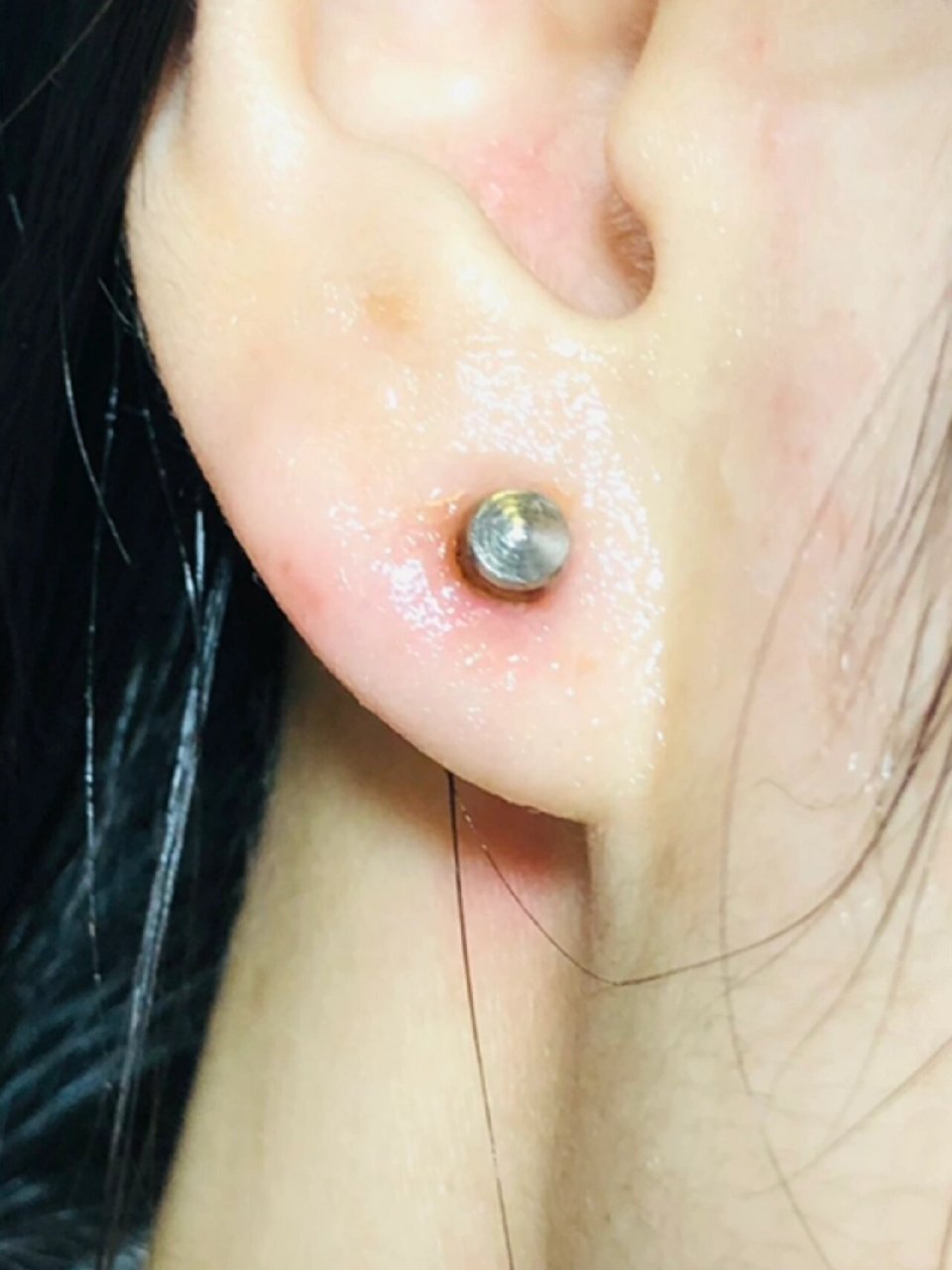 打耳洞半个月后发炎了.