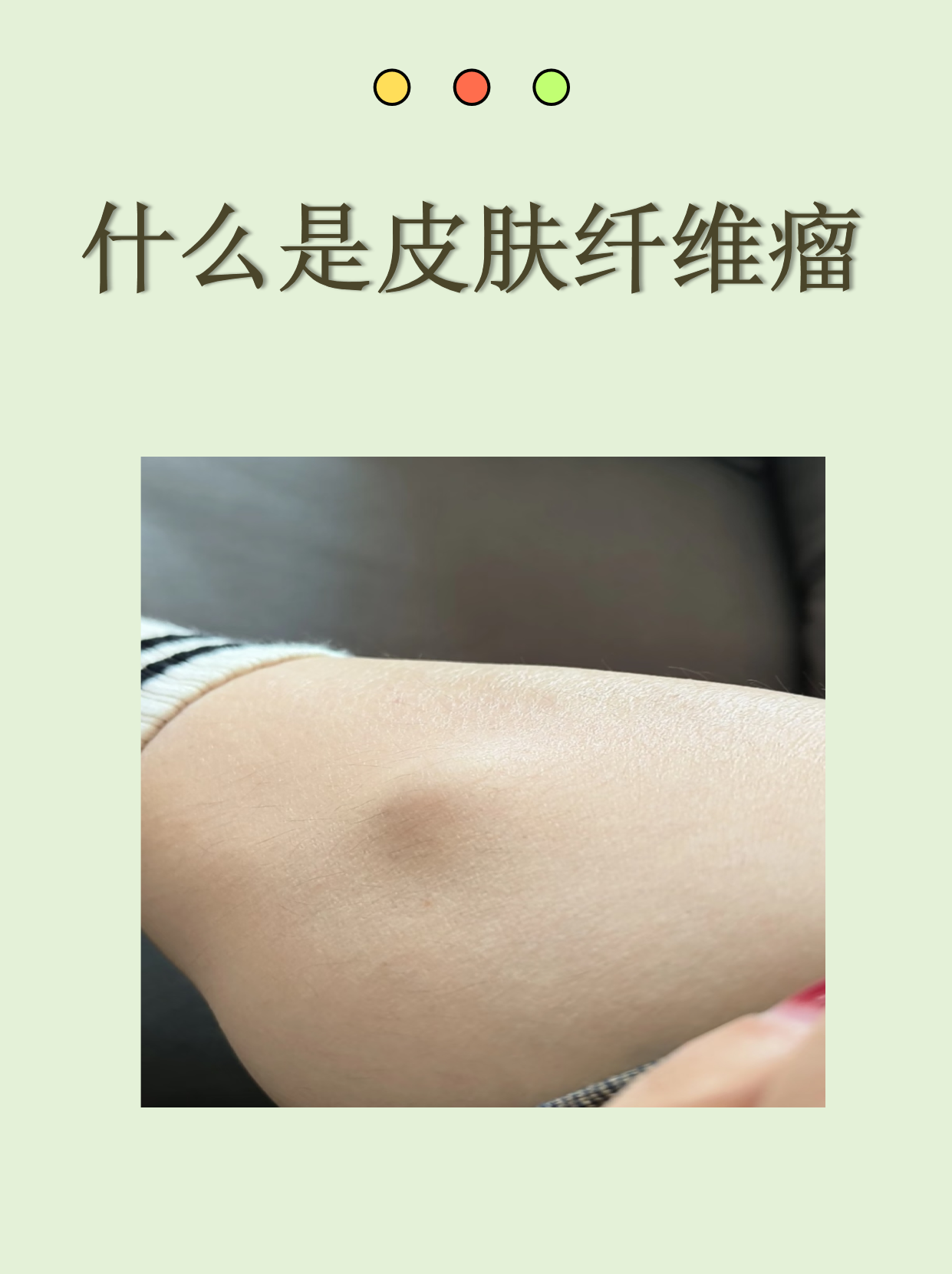 皮肤纤维瘤是一种常见的良性皮肤病变,看起来像个