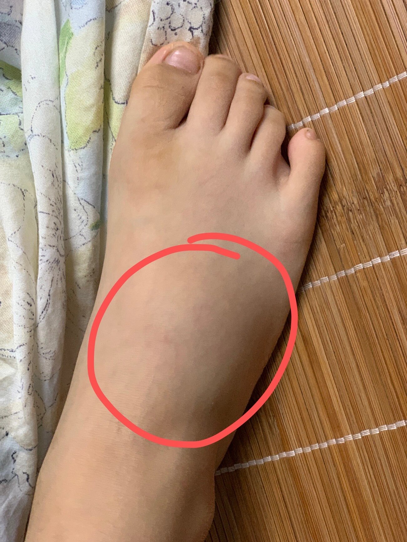 小孩脚背肿