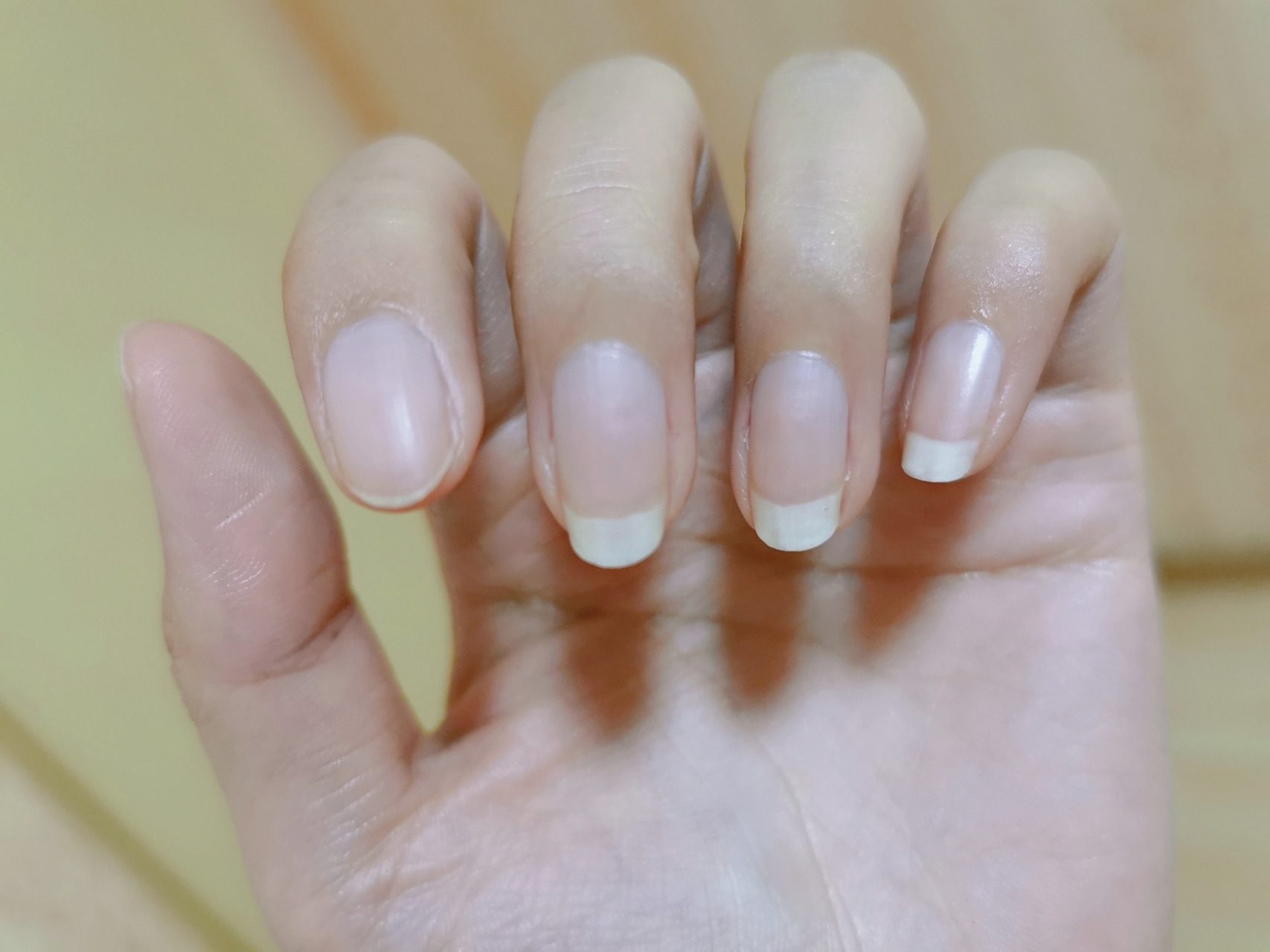 帮我康康,指甲长出来是不透明白色的 指甲长出来是不透明白色的,看