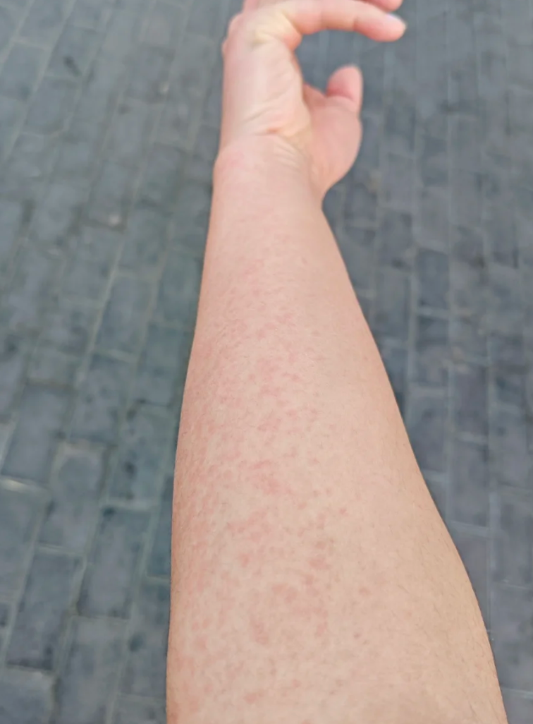 如果是过敏引起的,通常是皮肤接触了过敏原导致的反应