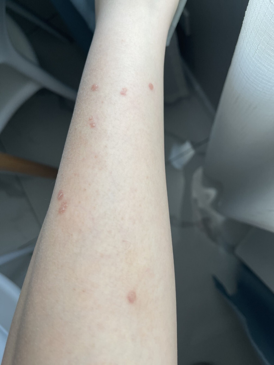 欣赏一下腿上的扁平疣