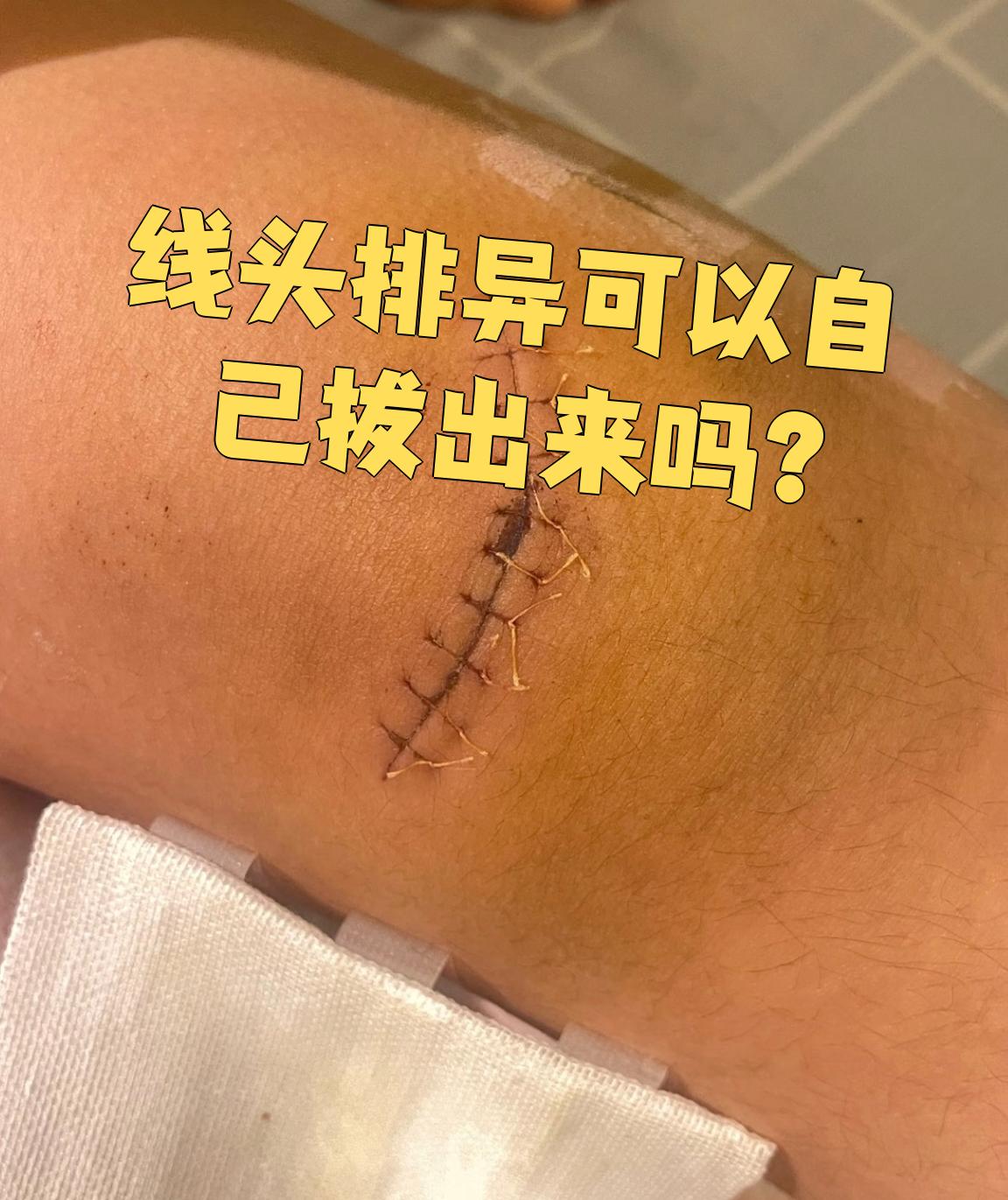 手术后如果发现线头排异,能不能自己拔出来要看具体情况