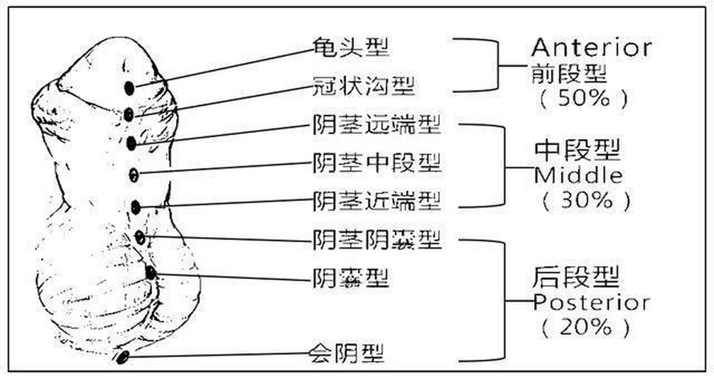 尿道下裂类型 98尿道下裂最早可以在宝宝出生的时候就可以发现 98