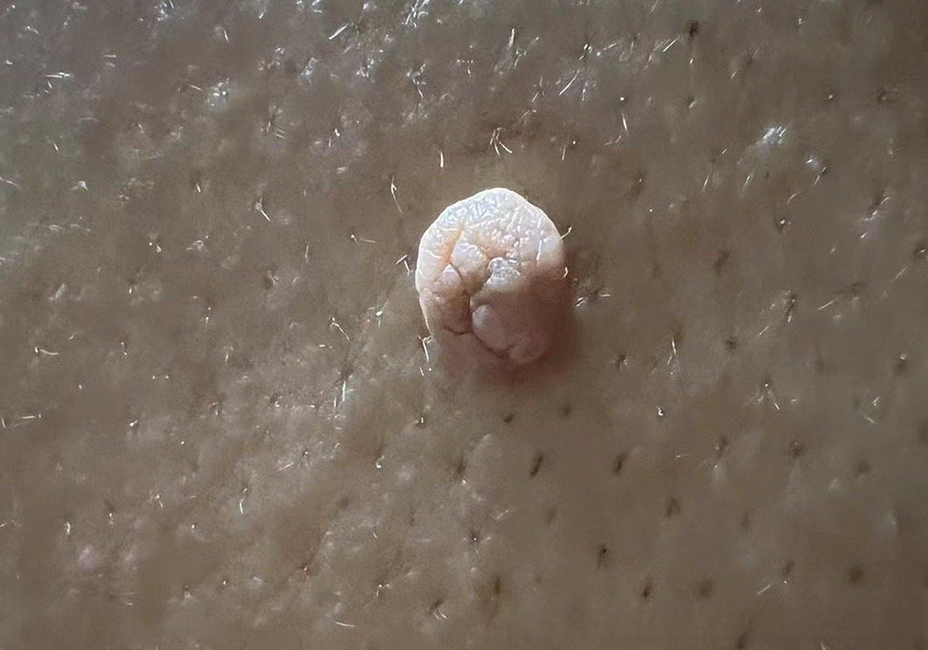 医疗的n种可能 图片表现是皮赘也叫软纤维瘤.