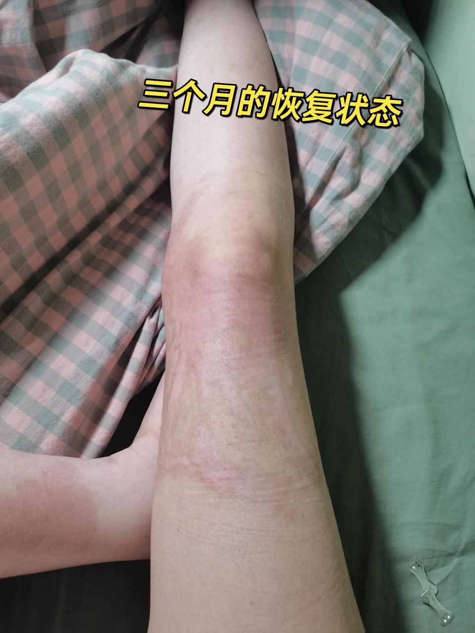 深二度烫伤三个月恢复状态 从烫伤到现在大概有三个月了,为了预防疤痕