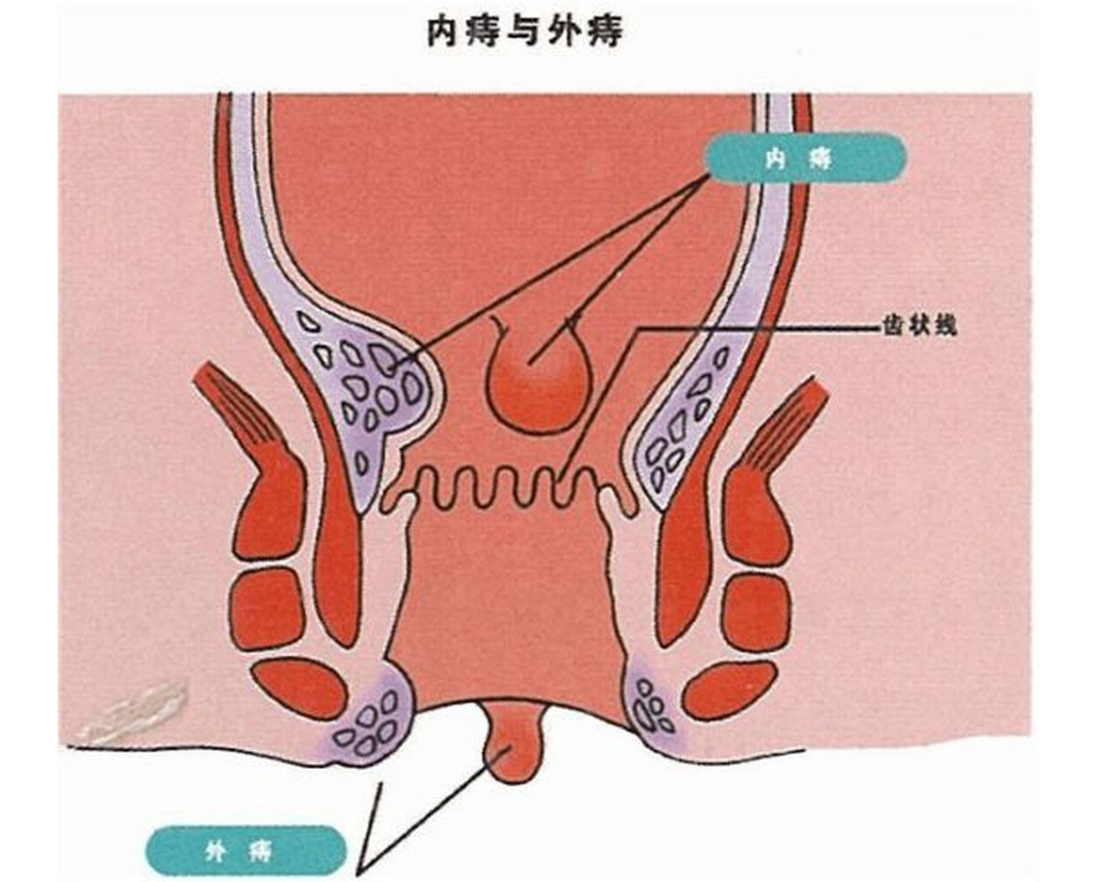 痔疮出血怎么办?