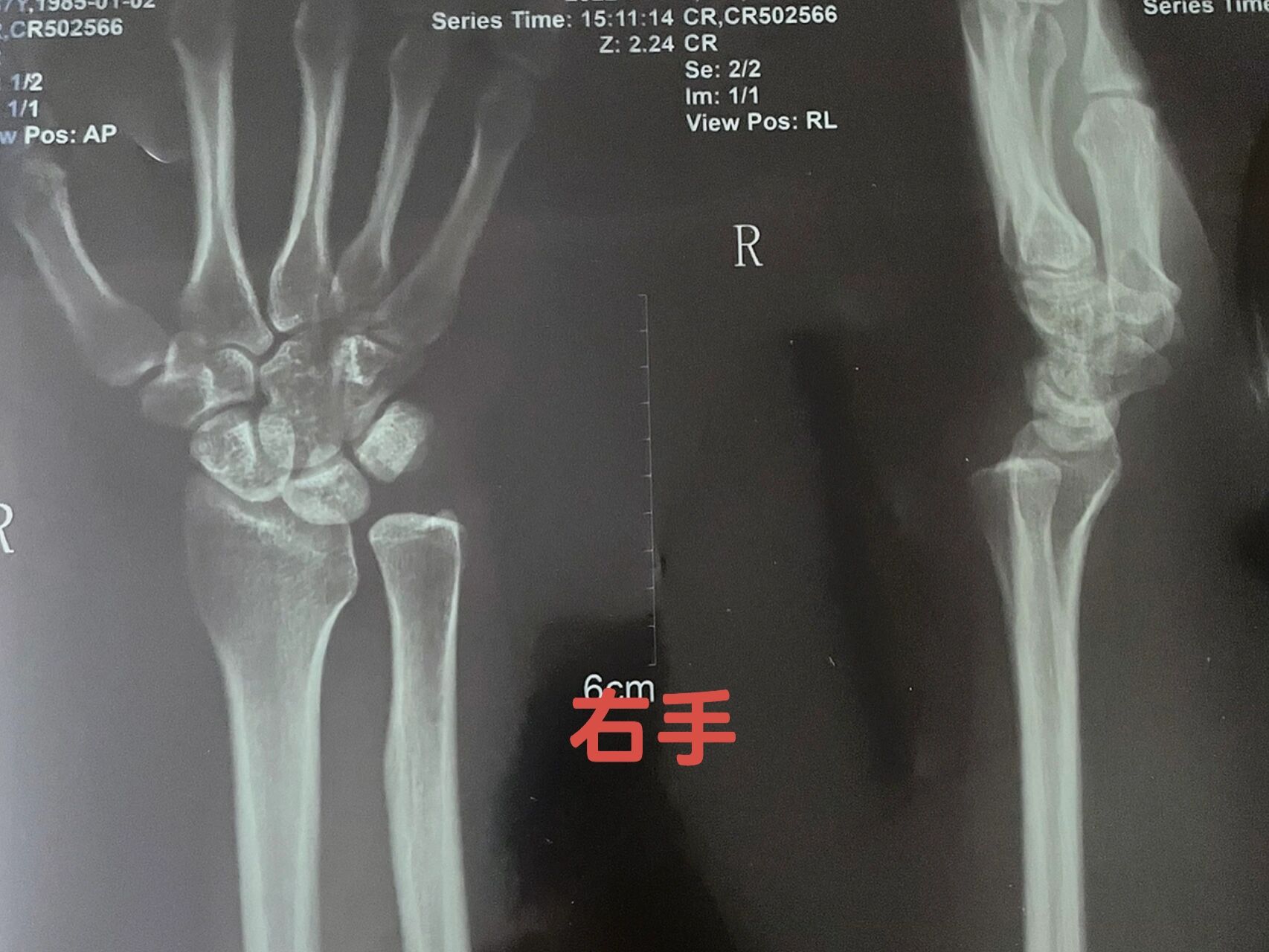 双下尺桡关节脱位 左手感觉不是很严重