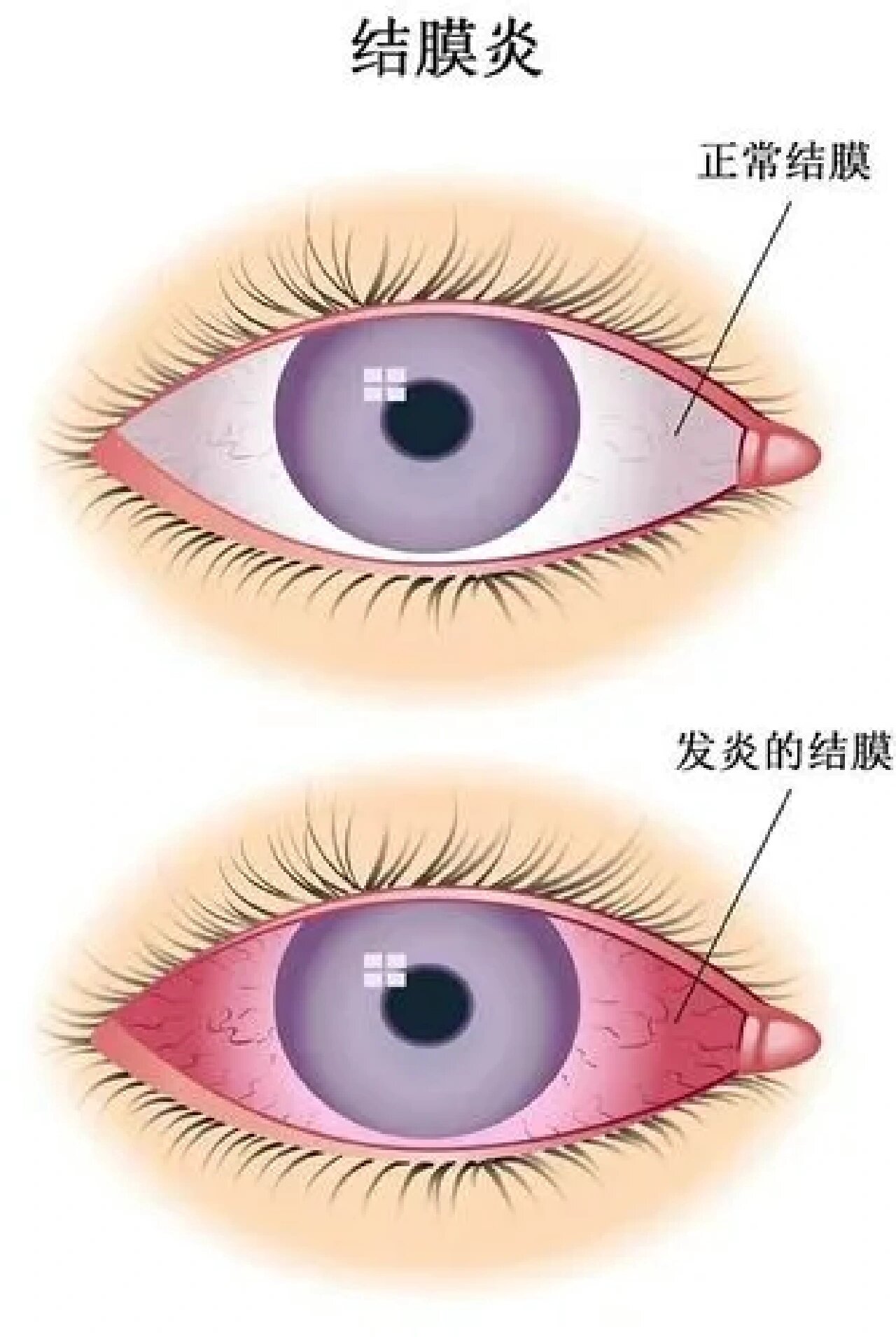 正常睑结膜图片