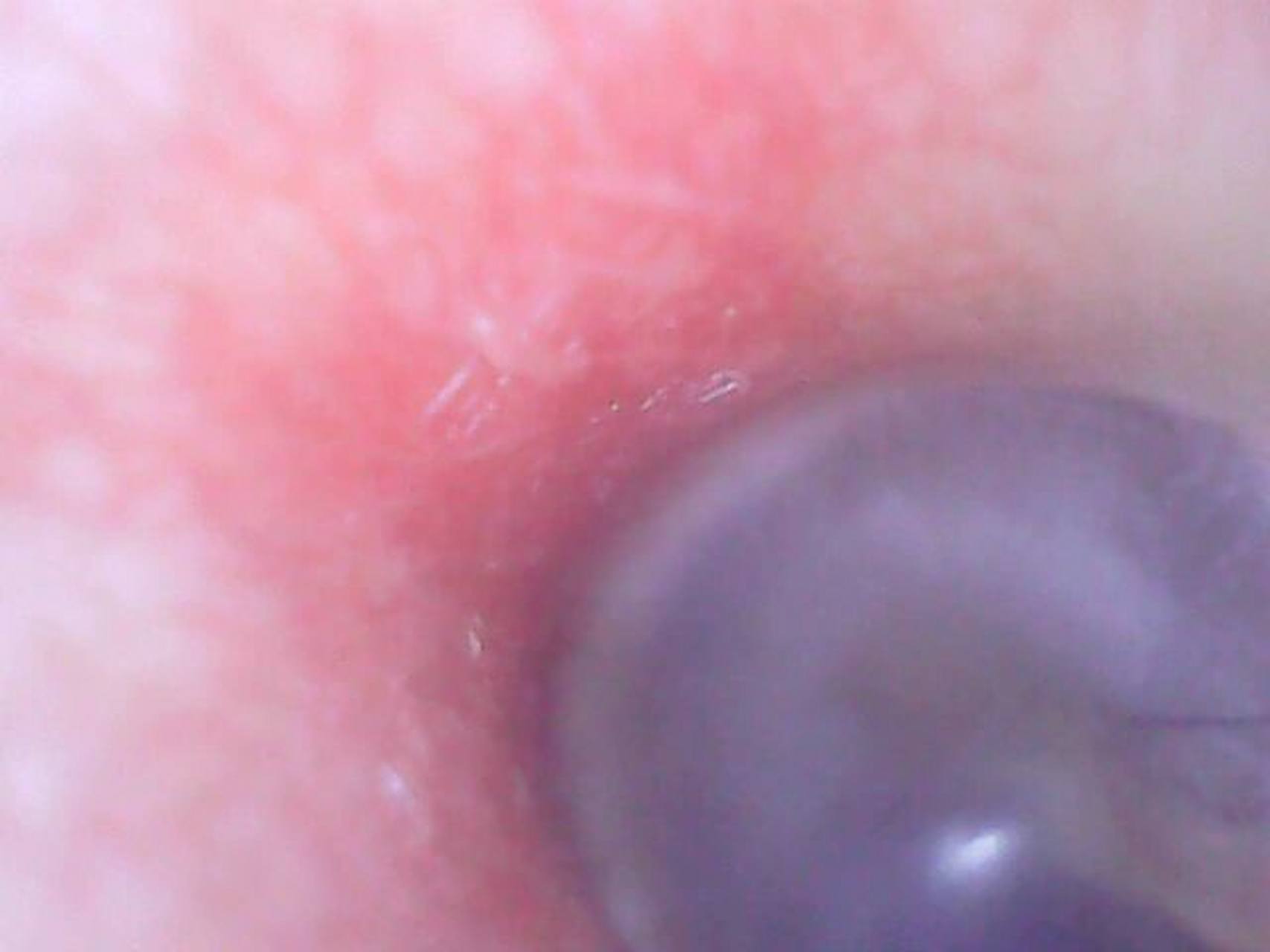 原来耳膜是这样的,偶尔有点痛,发红了像发炎