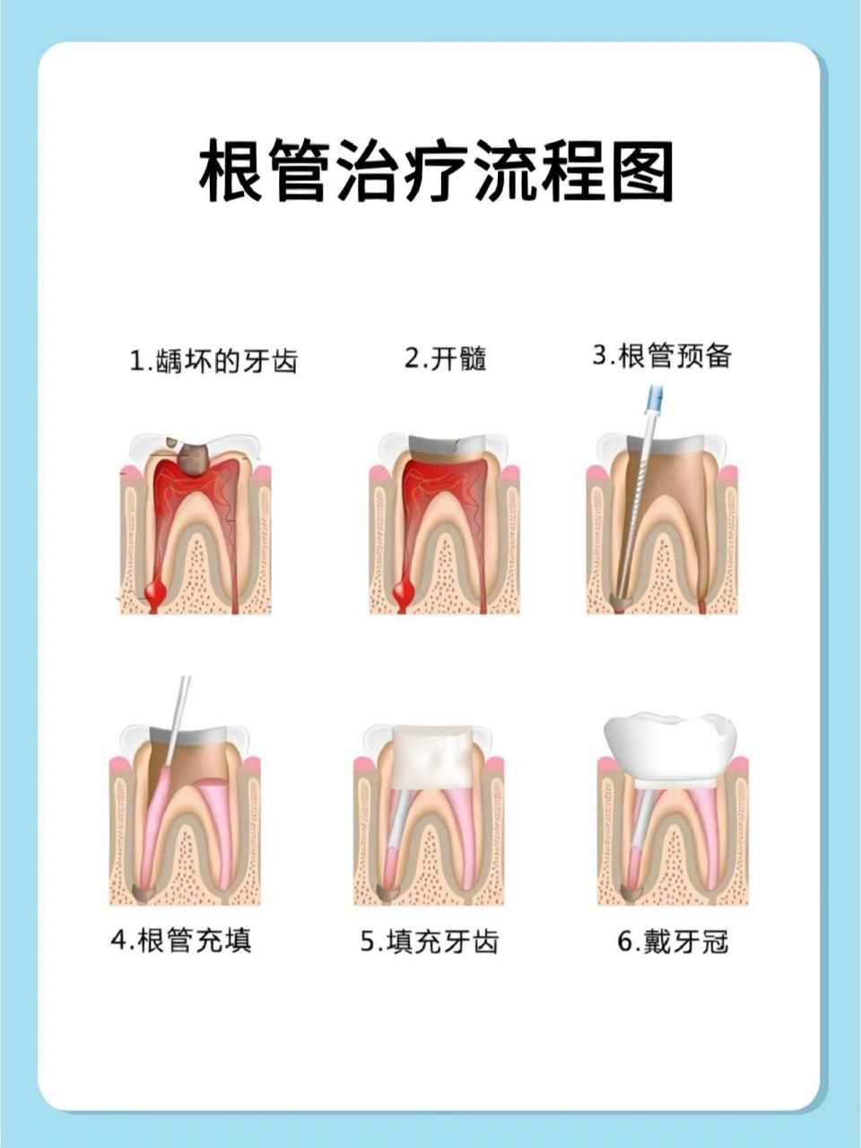 牙齿根管治疗图片步骤图片