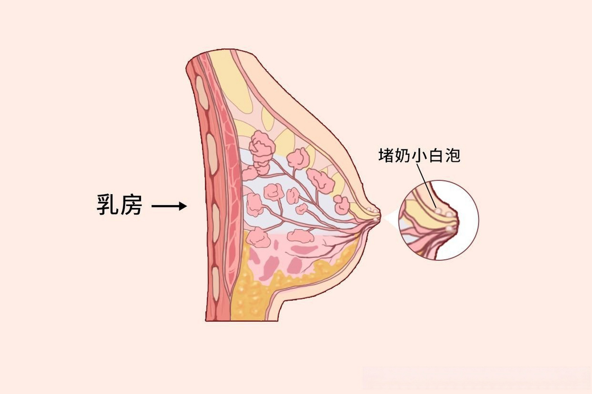 乳头有白色 凸起图片