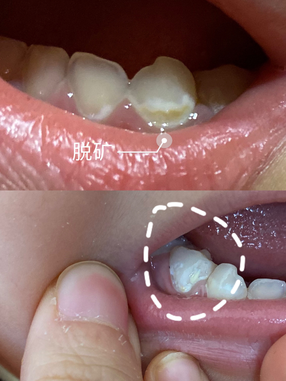 带宝宝看牙医,被说成人傻钱多 孩子20几个月发现两颗门牙有龋坏,便