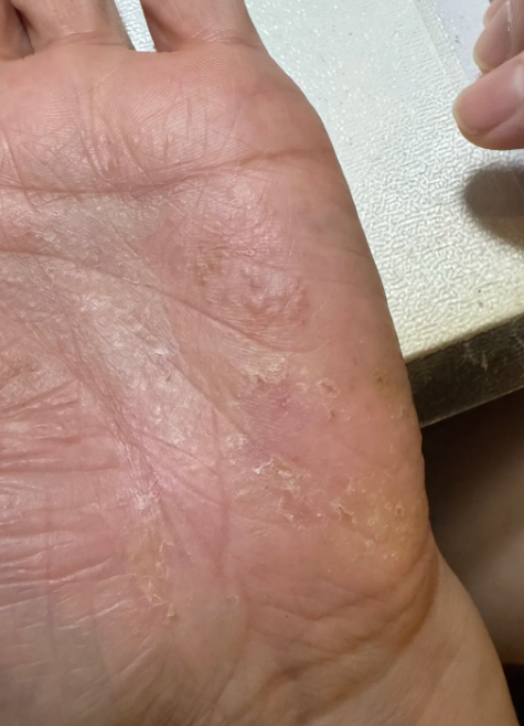 夏天手上起小水泡,发红还特别痒,这种情况最常见的有四种可能:虫咬