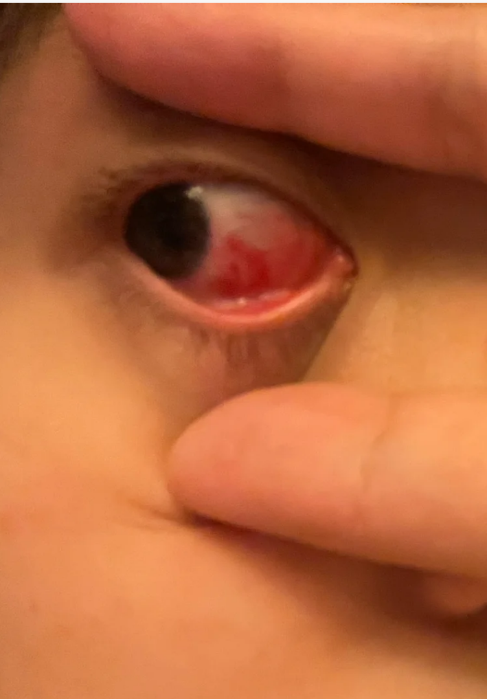 5天,伤口眼白划伤眼睛流血的照片 小孩小孩眼睛流血