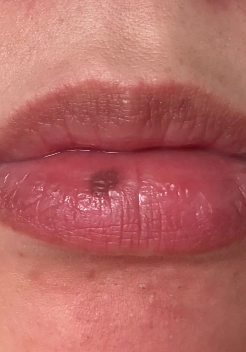 嘴唇上出现黑色小点最常见的原因是黑色素沉着或黑痣