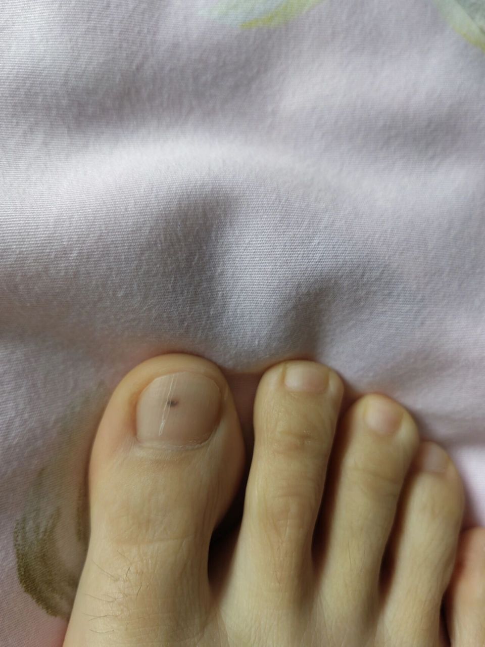 不会变大 只随着指甲长长 指甲长了减掉 又会从甲床重新长黑点点 说是