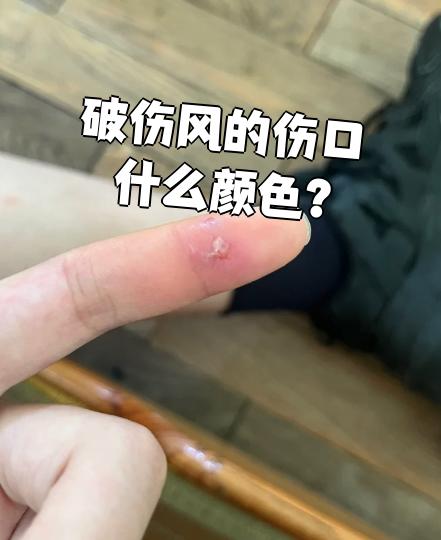 破伤风的伤口没有特定颜色