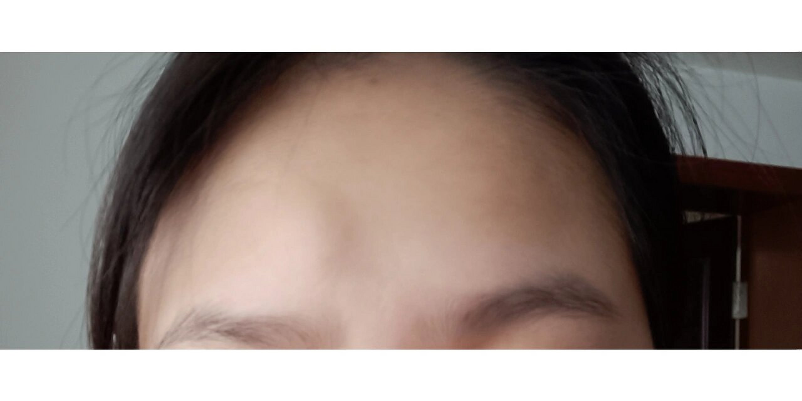 额头脂肪瘤 想去医院把额头上的脂肪瘤嘎了,有没有姐妹知道应该挂啥科