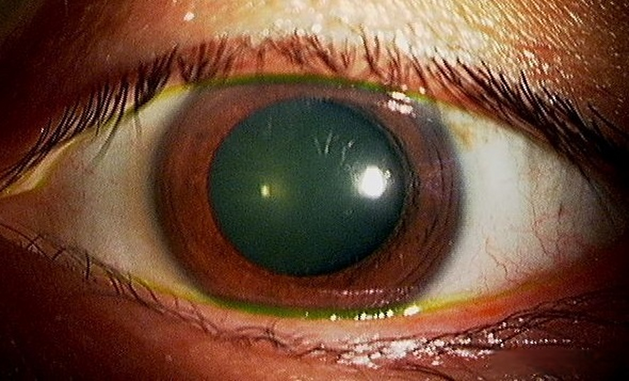 眼健康光明计划# 飞蚊症是玻璃体混浊的一种表现.