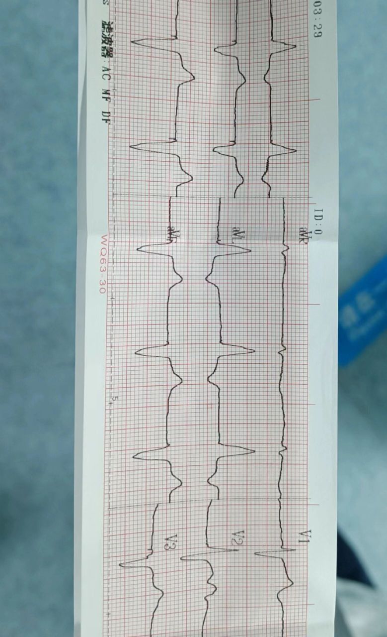 规培Ⅰ起搏器心电图 心室起搏器,qrs波前有明显的起搏钉!