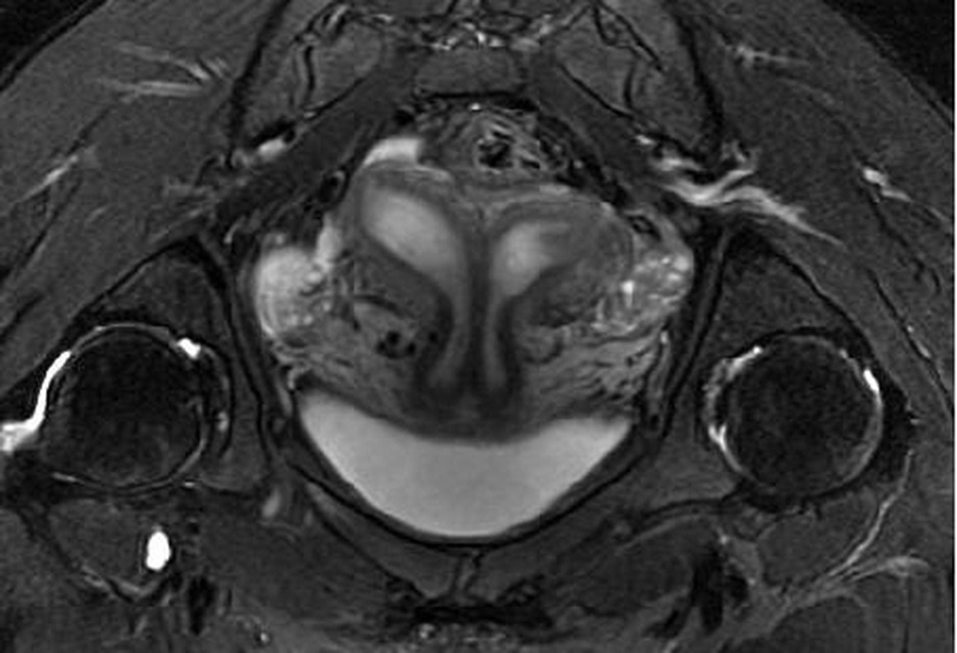磁共振显示:双子宫畸形.医学影像 人体结构 子宫 畸形