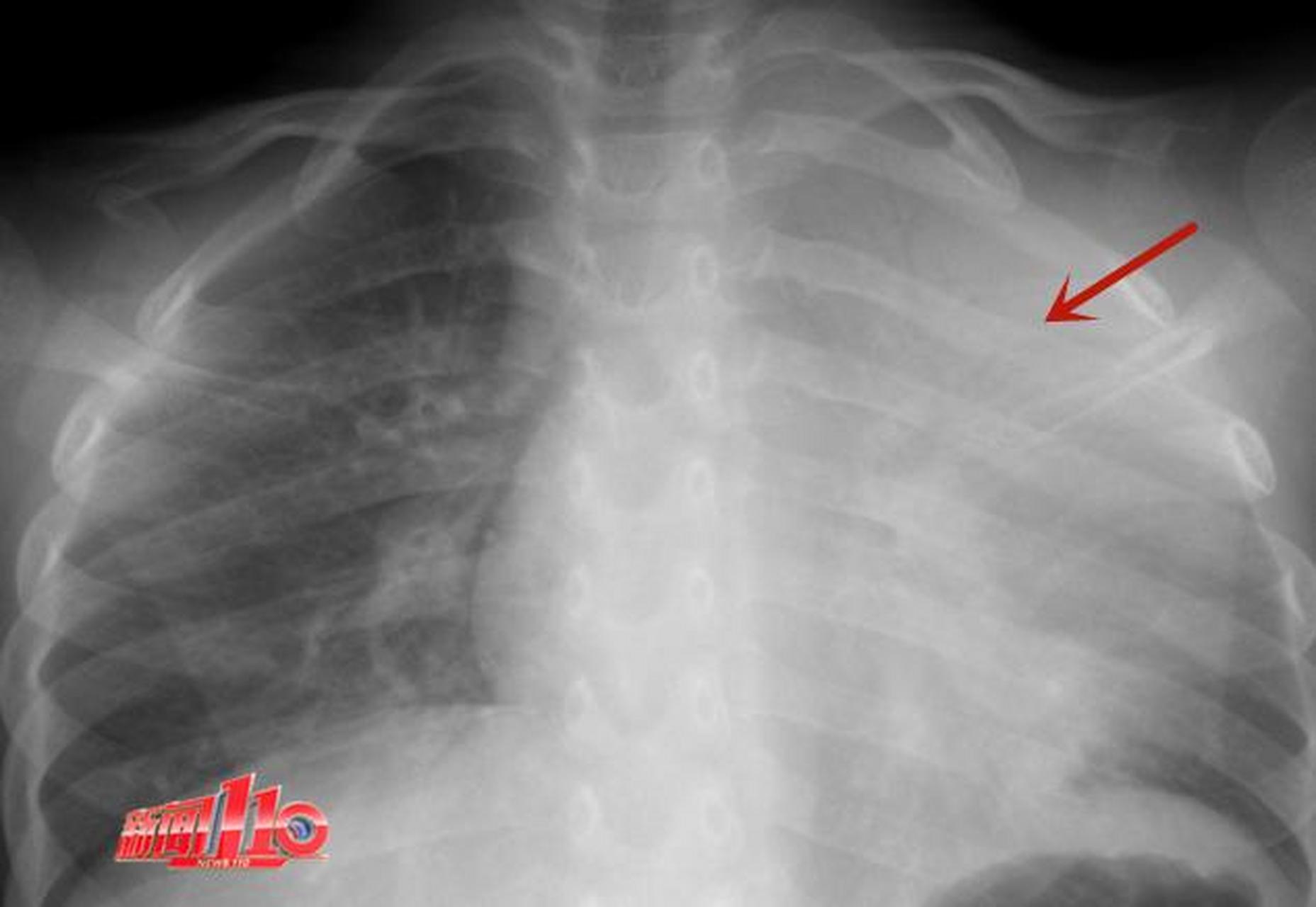 【福州6岁女童反复发烧,左肺接近白肺!这种疾病目前处于发病小高峰!】